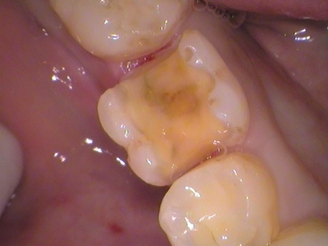 銀歯　セラミックインレー　虫歯　自由が丘　歯医者