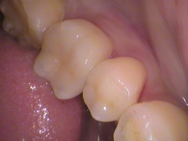 銀歯　虫歯　セラミック　自由が丘　歯医者