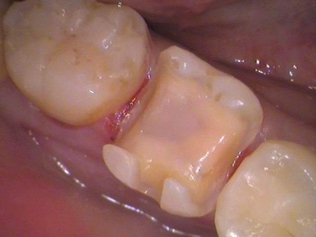 銀歯　セラミックインレー　虫歯　自由が丘　歯医者