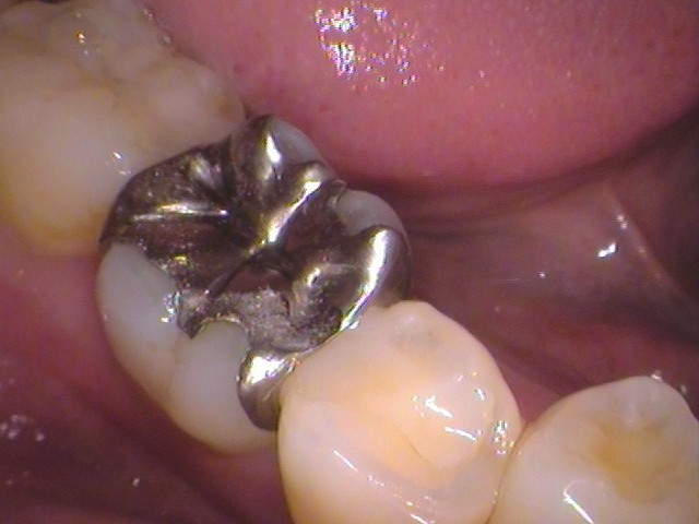 銀歯　セラミックインレー　虫歯　自由が丘　歯医者