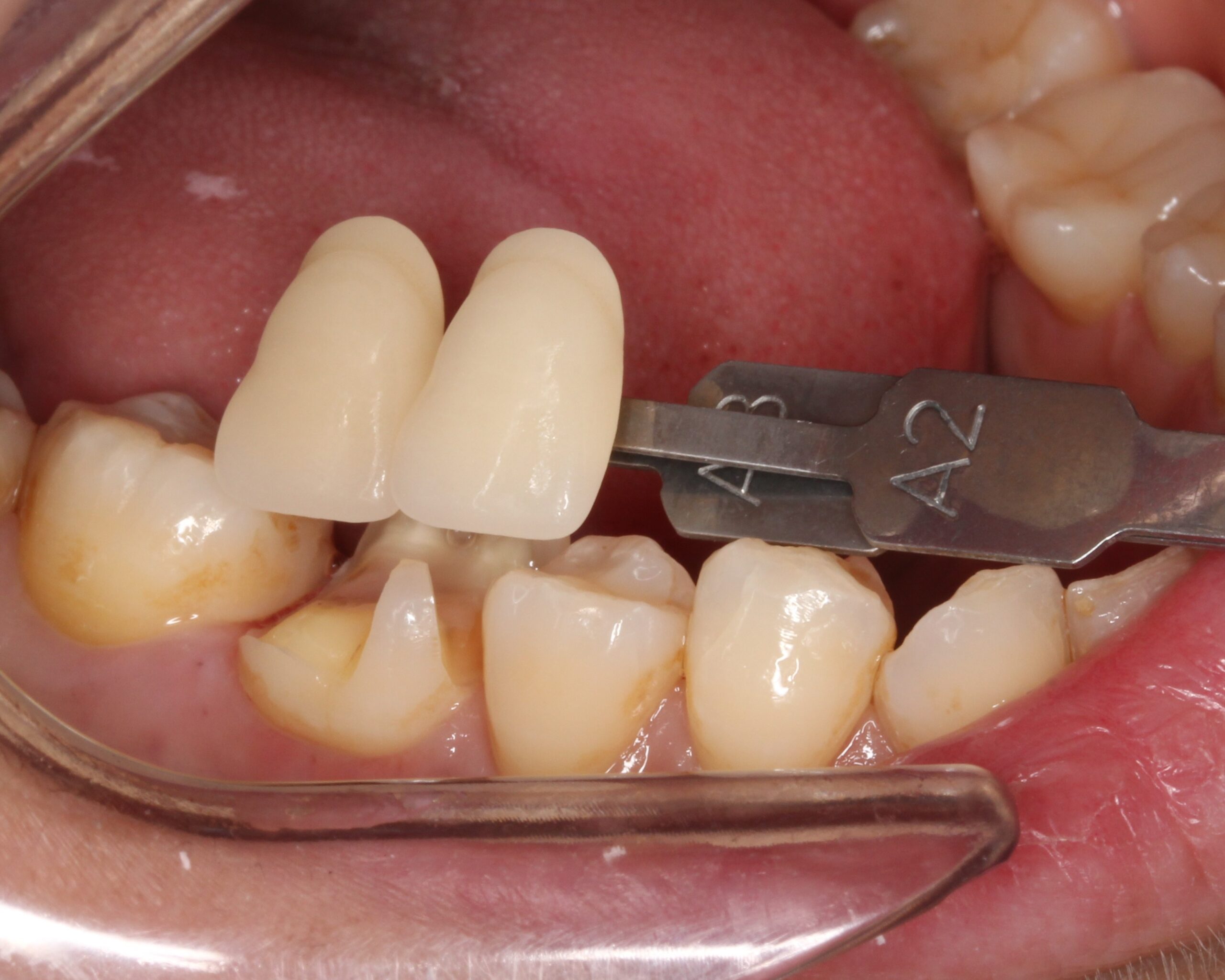 銀歯　セラミックインレー　虫歯　自由が丘　歯医者