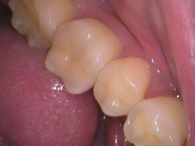 銀歯　虫歯　セラミック　自由が丘　歯医者