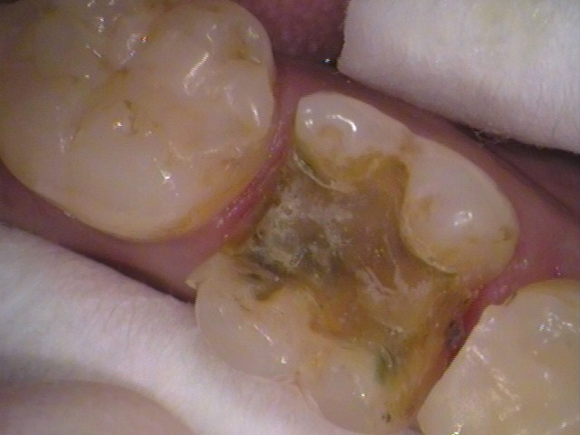 銀歯　セラミックインレー　虫歯　自由が丘　歯医者