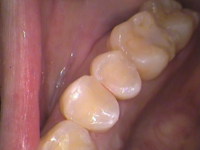 レジン　虫歯　セラミック　自由が丘　歯医者