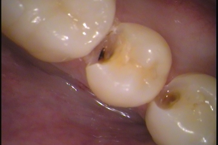 象牙質に進行されている虫歯C2