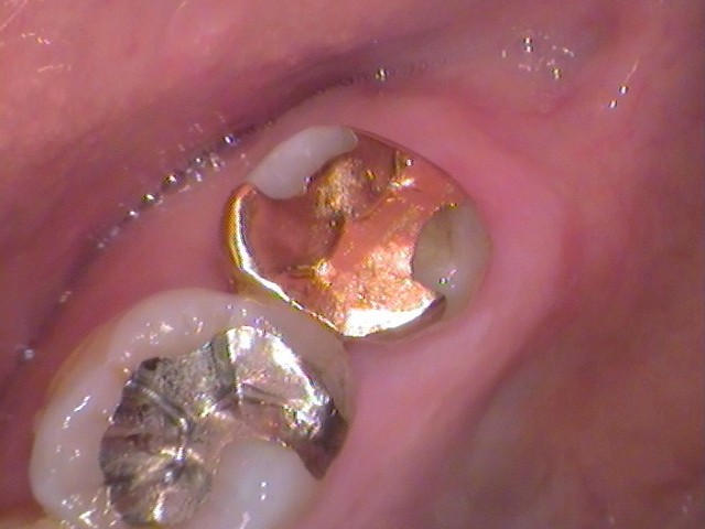 ゴールドインレー