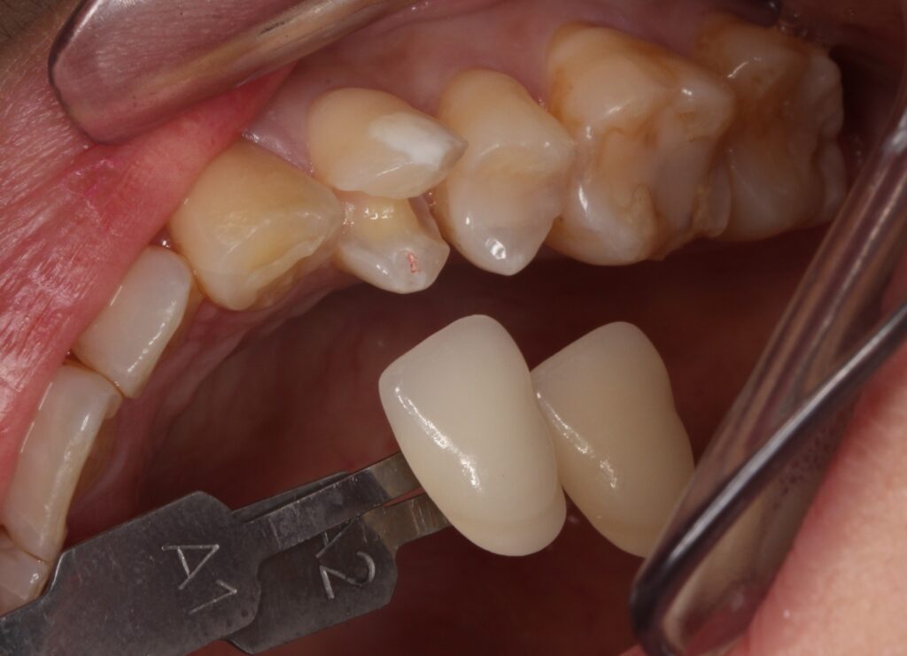レジン　虫歯　セラミック　自由が丘　歯医者
