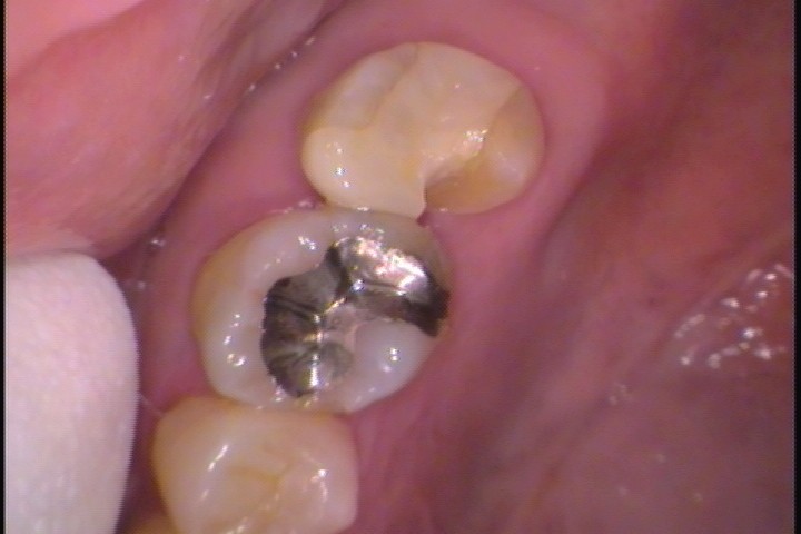 欠けたセラミックインレー