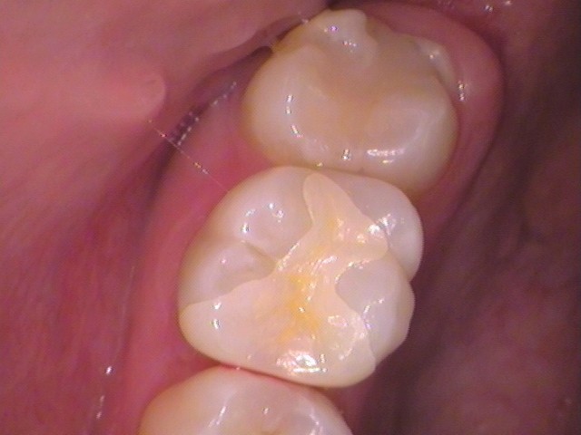 ジルコニアインレーの入った歯