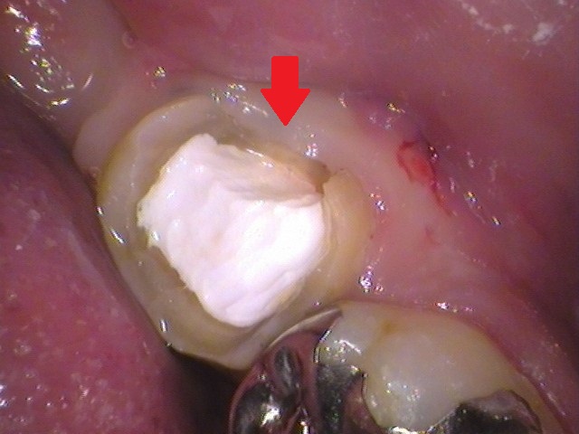 根管治療　治らない　歯医者　自由が丘