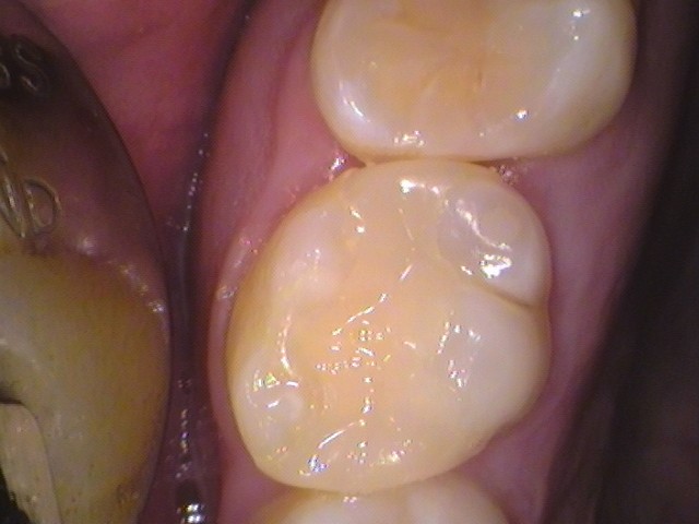 フロス引っかかる　セラミック治療　自由が丘　歯医者