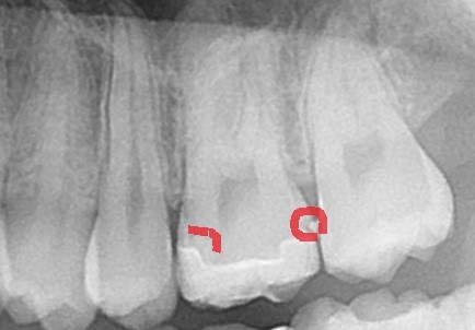 セラミック治療　フロス引っかかる　歯医者　自由が丘