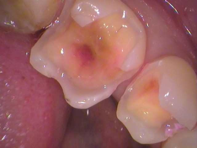 銀歯　虫歯　セラミック　　歯医者　自由が丘