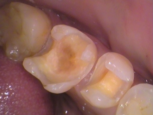 銀歯　虫歯　セラミック　　歯医者　自由が丘