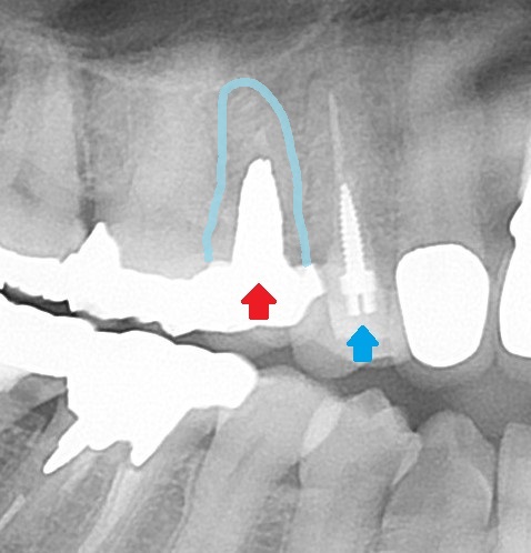 メタルコア　根管治療　自由が丘　歯医者