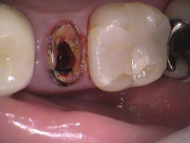 メタルコア　根管治療　自由が丘　歯医者