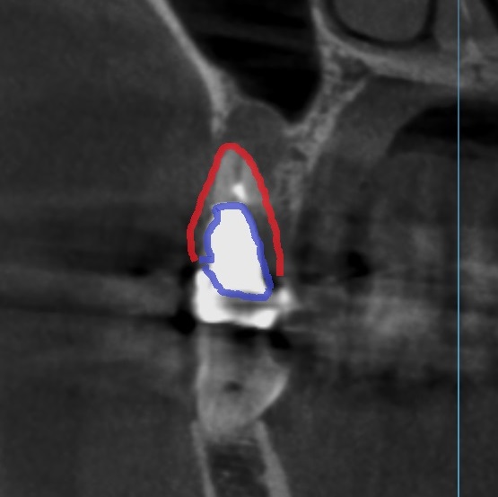 メタルコア　根管治療　自由が丘　歯医者