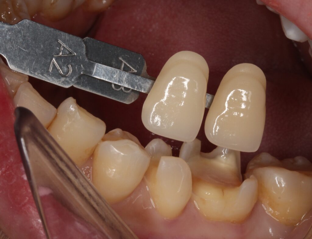 銀歯　虫歯　セラミック　　歯医者　自由が丘