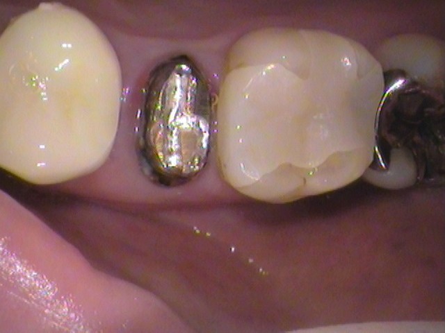 メタルコア　根管治療　自由が丘　歯医者