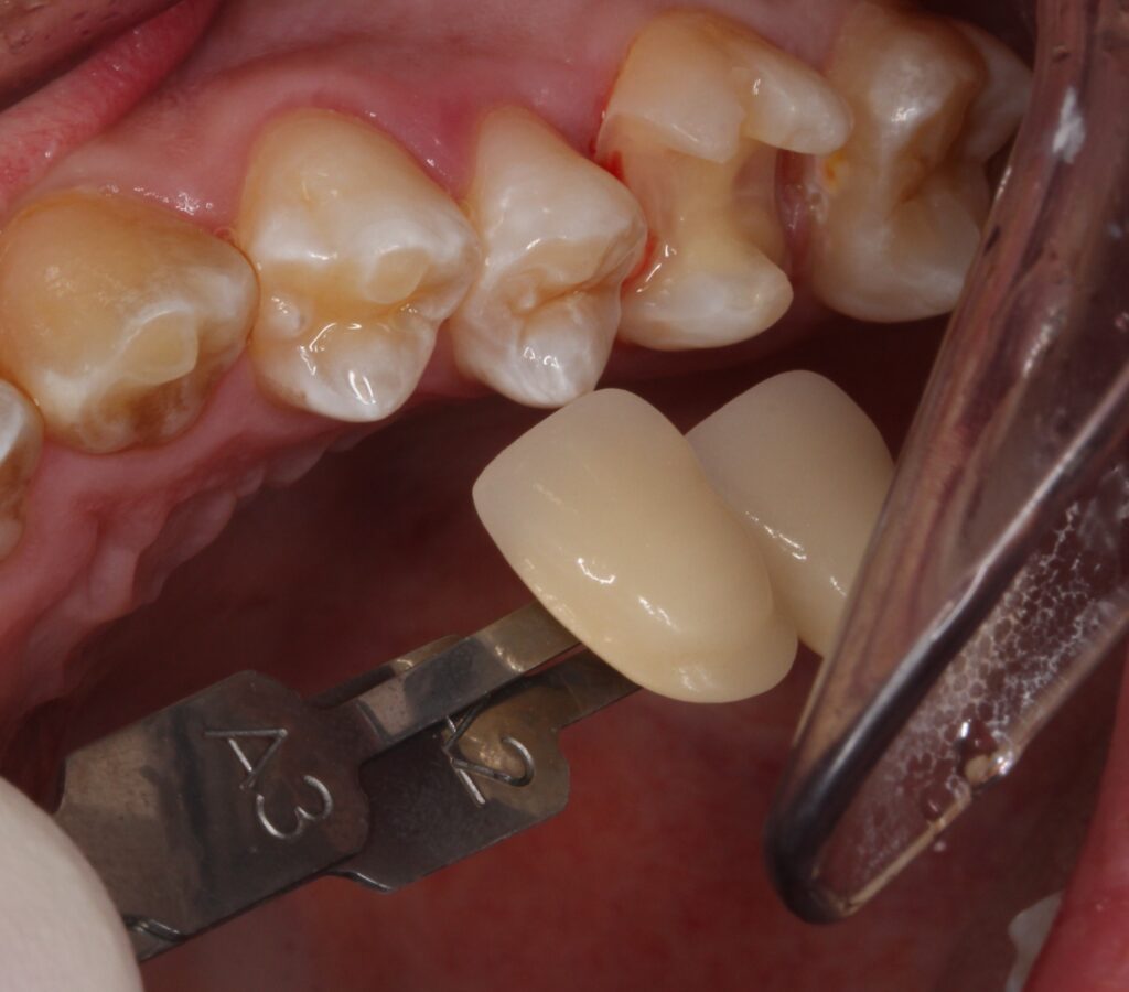 フロス引っかかる　セラミック治療　自由が丘　歯医者