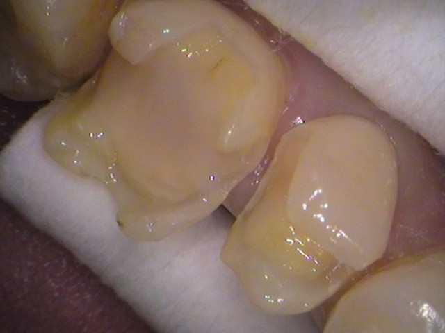 銀歯　虫歯　セラミック　　歯医者　自由が丘