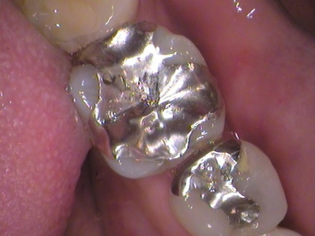 銀歯　虫歯　セラミック　　歯医者　自由が丘