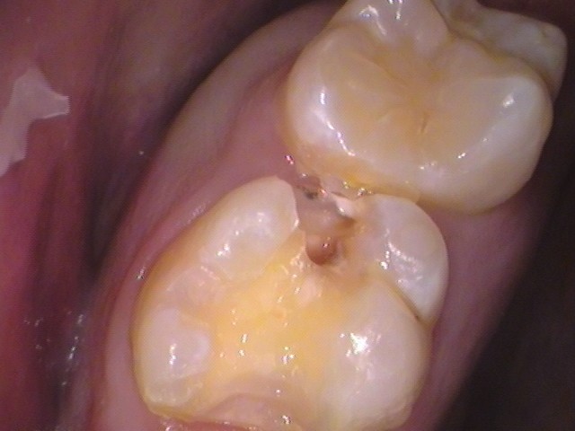 フロス引っかかる　セラミック治療　自由が丘　歯医者
