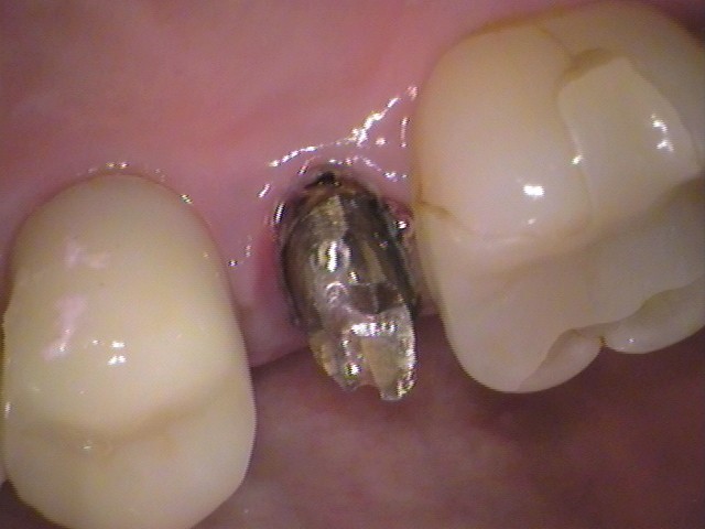 メタルコア　根管治療　自由が丘　歯医者