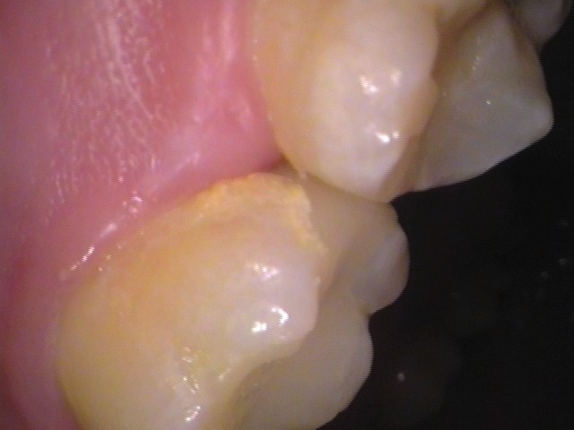 フロス引っかかる　セラミック治療　自由が丘　歯医者