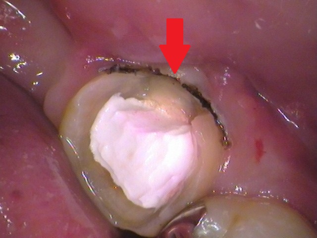 根管治療　治らない　歯医者　自由が丘
