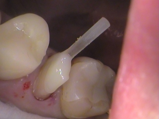 メタルコア　根管治療　自由が丘　歯医者