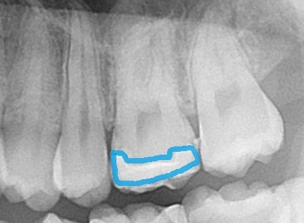 セラミック治療　フロス引っかかる　歯医者　自由が丘