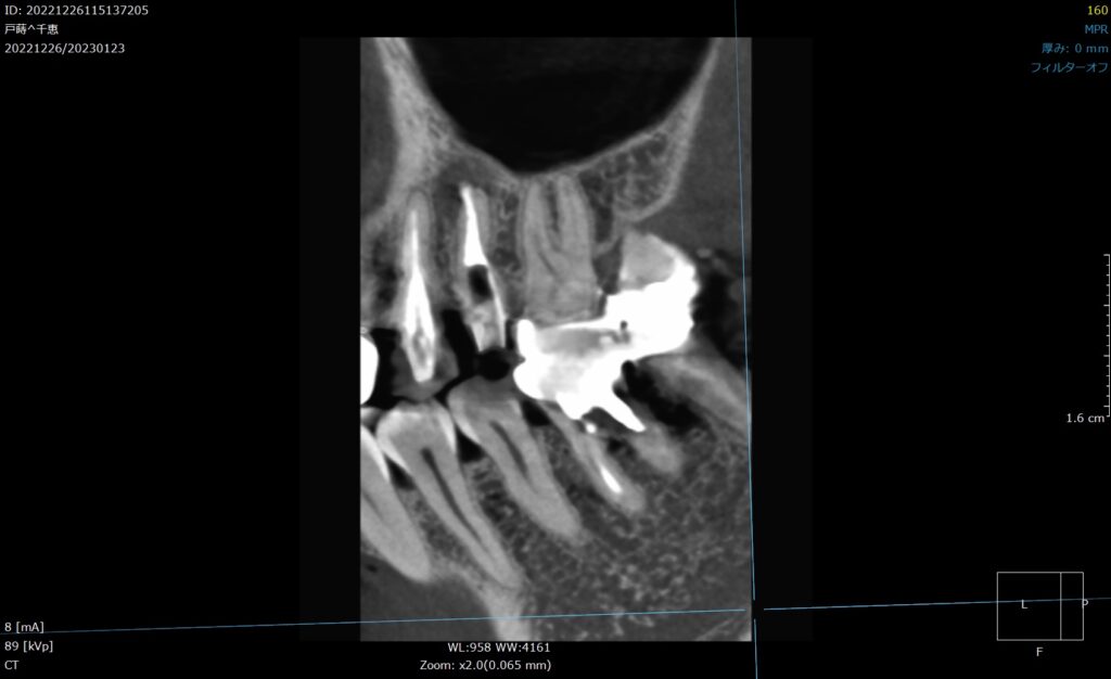 メタルコア　根管治療　自由が丘　歯医者