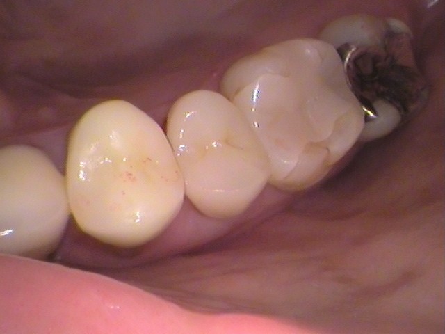 メタルコア　根管治療　自由が丘　歯医者