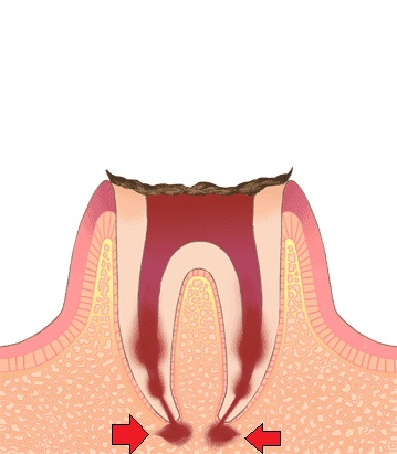 根管治療　噛むと痛い　歯医者　自由が丘