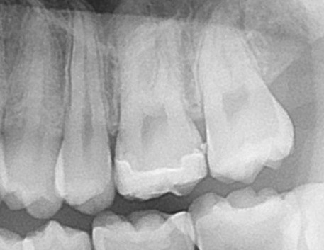 セラミック治療　フロス引っかかる　歯医者　自由が丘