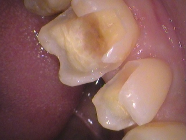銀歯　虫歯　セラミック　　歯医者　自由が丘