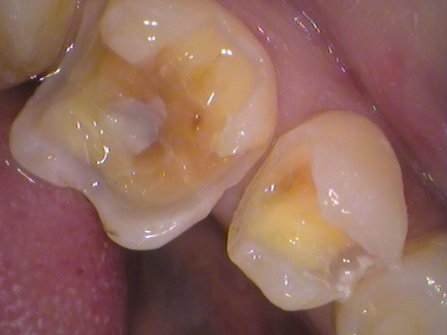 銀歯　虫歯　セラミック　　歯医者　自由が丘