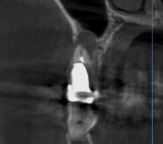 メタルコア　根管治療　自由が丘　歯医者