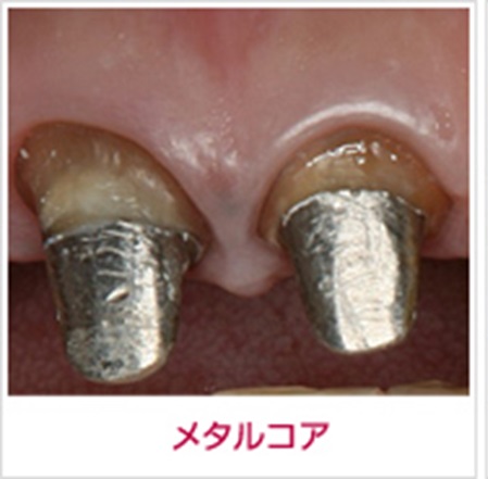 メタルコア　根管治療　自由が丘　歯医者