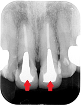 メタルコア　根管治療　自由が丘　歯医者