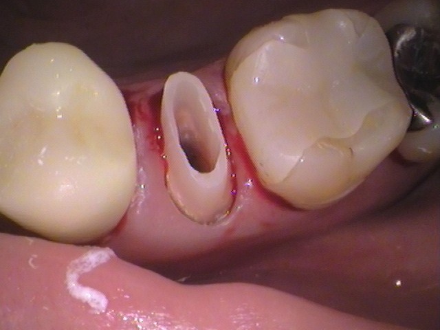 メタルコア　根管治療　自由が丘　歯医者