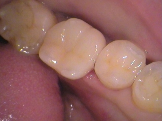 銀歯　虫歯　セラミック　　歯医者　自由が丘