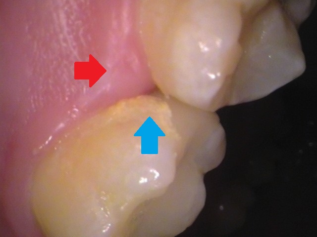 フロス引っかかる　セラミック治療　自由が丘　歯医者