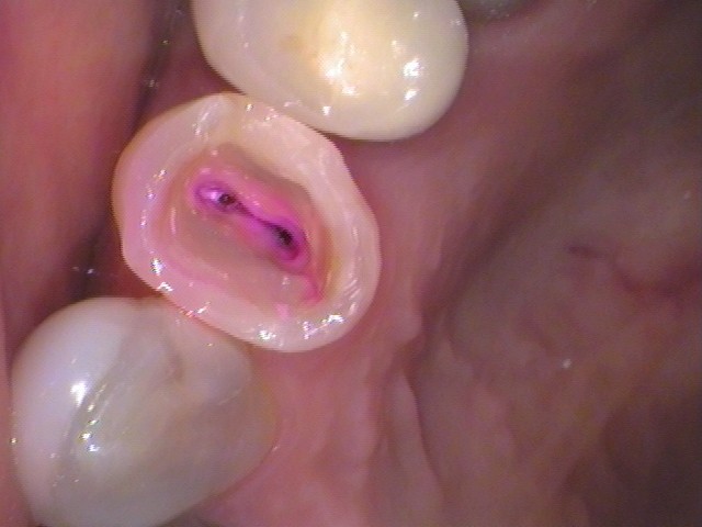 根管治療　治らない　自由が丘　歯医者