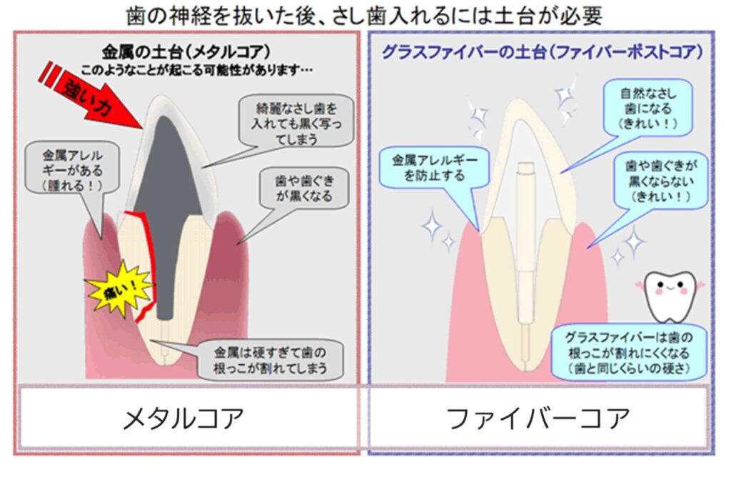 メタルコア　根管治療　自由が丘　歯医者