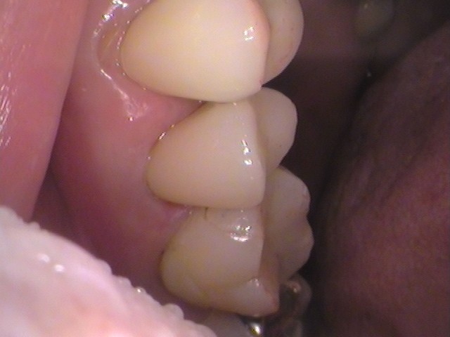 メタルコア　根管治療　自由が丘　歯医者