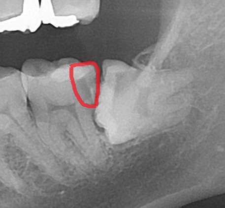 親知らず　虫歯　自由が丘　歯医者