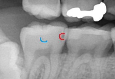 歯の黒い線　虫歯　セラミック　歯医者　自由が丘