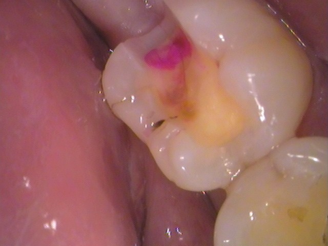 銀歯　虫歯　歯が欠けた　自由が丘　歯医者